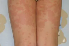 薬疹 写真  太田こどもとアレルギークリニック 新潟県長岡市の小児科 