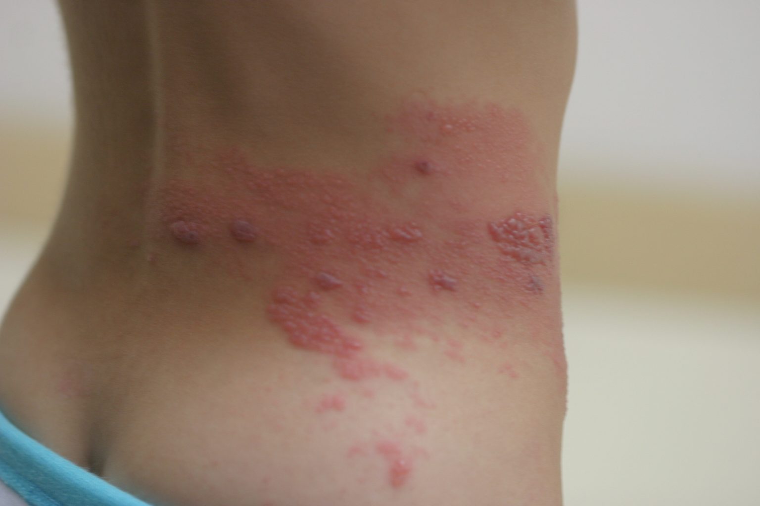 酒さおよび頬部発疹